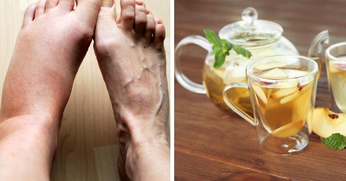 swelling in feet
